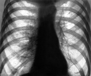 emfizema-legkih-rentgen